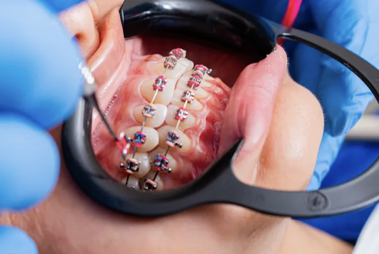 Braces in Louisville, KY